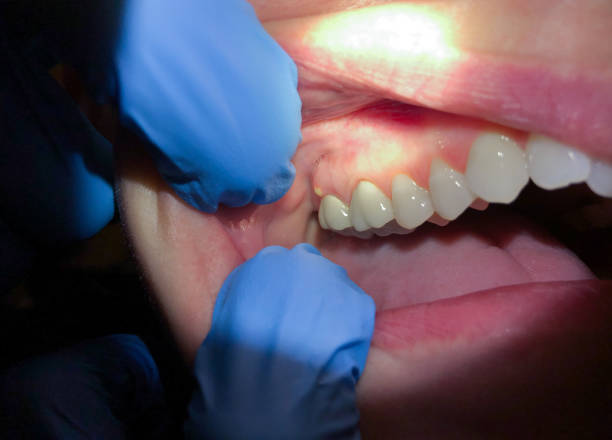 Best Emergency Wisdom Teeth Removal in Scott Af, IL
